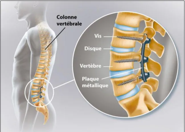 Figure 16 : Radiographie arthrodèse vertébrale (43) 