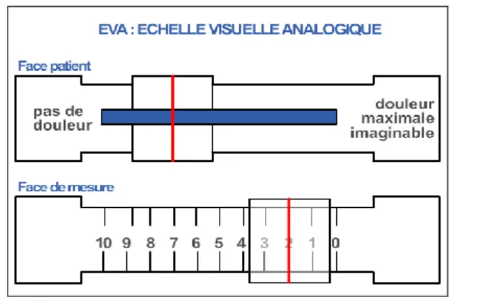 Figure 7 Echelle visuelle analogique de la douleur (27) 