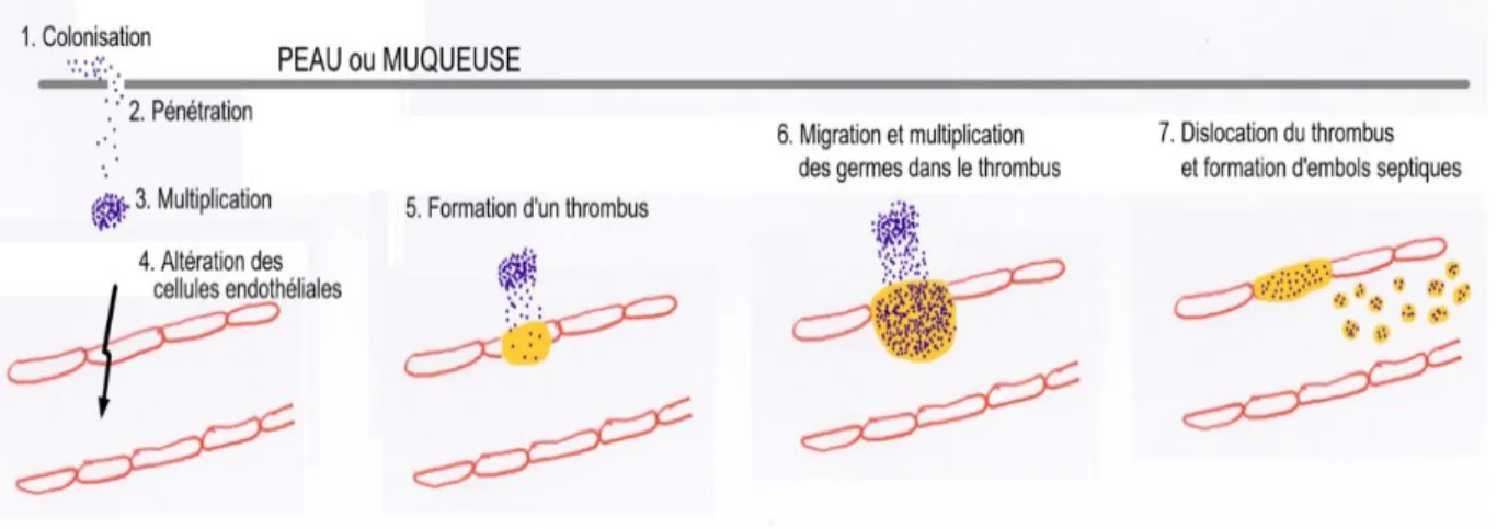 Figure 1 : Schéma physiopathologique simplifié des bactériémies d'origine  thrombophlébitique (5) 