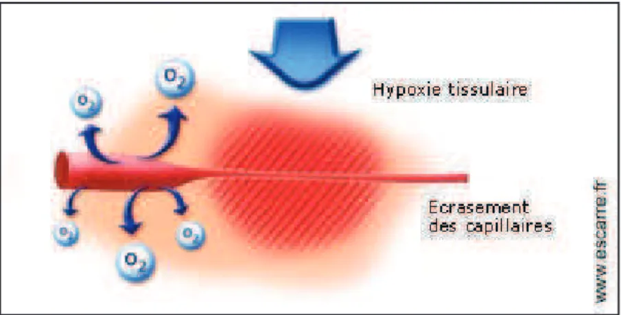 Figure 2 : Hypoxie tissulaire entrainée par la pression sur un  vaisseau. (7)  