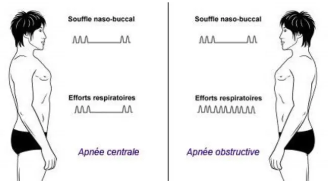 Figure 1 : Apnées centrales et obstructives, adapté d’après « www.orthoapnea.com ». 