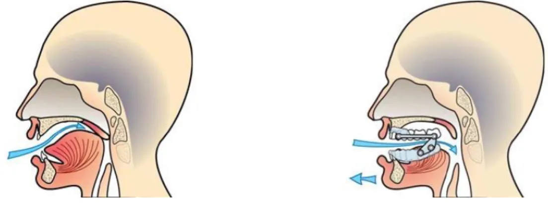 Figure 9 : Positionnement et effet sur le flux ventilatoire d'une orthèse d'avancée mandibulaire