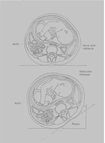 Figure 14 : Compression des veines par l'utérus 
