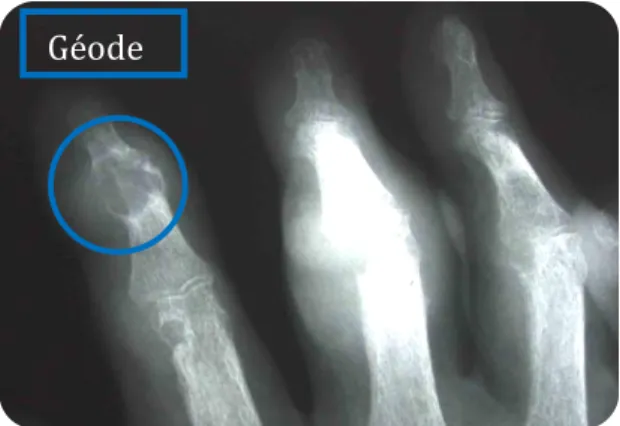 Figure 13 : Destructions totales des articulations  inter-phalangiennes des pieds chez un patient 