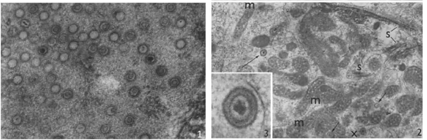 Figure  1  :  Particules  d’EBV  visualisées  en  microscopie  électronique  (Epstein  et  al.,  1965)  (1) Coupe de lymphoblaste contenant de nombreuses particules immatures d’environ 75nm de  diamètre,  délimitées  par une  simple membrane et  de  profil
