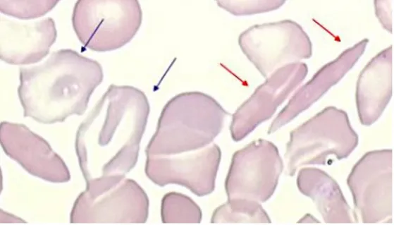 Figure   11   :   Frottis   sanguin   chez   un   patient   drépanocytaire   composé   de   drépanocytes   (flèche   rouge)   et   de    réticulocytes   de   stress   (flèche   bleue)   (Site   internet   n°34) 