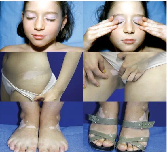 Figure 8: Illustration du phénomène de Koebner au cours du vitiligo D'après Ezzedine et al