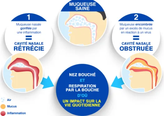 Figure 5 : Mécanisme de l'obstruction nasale (11)  