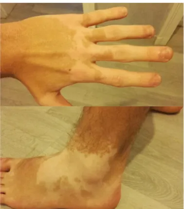 Figure 4: Exemple de lésions de vitiligo (Photos personnelles) 