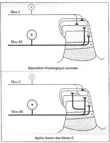 Figure 11 : Représentation schématique de la plasticité histologique à l'origine d'allodynie (27) 