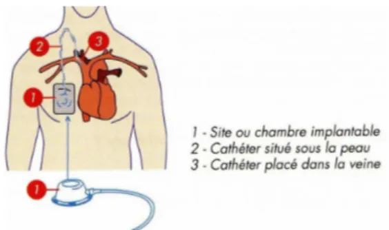 Figure 6. Schéma de principe d'une chambre implantable. 