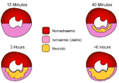 Figure 5 : Illustration de la propagation de la nécrose des cellules myocardique, de la zone endocardique vers  la zone péricardique selon la durée de l’ischémie