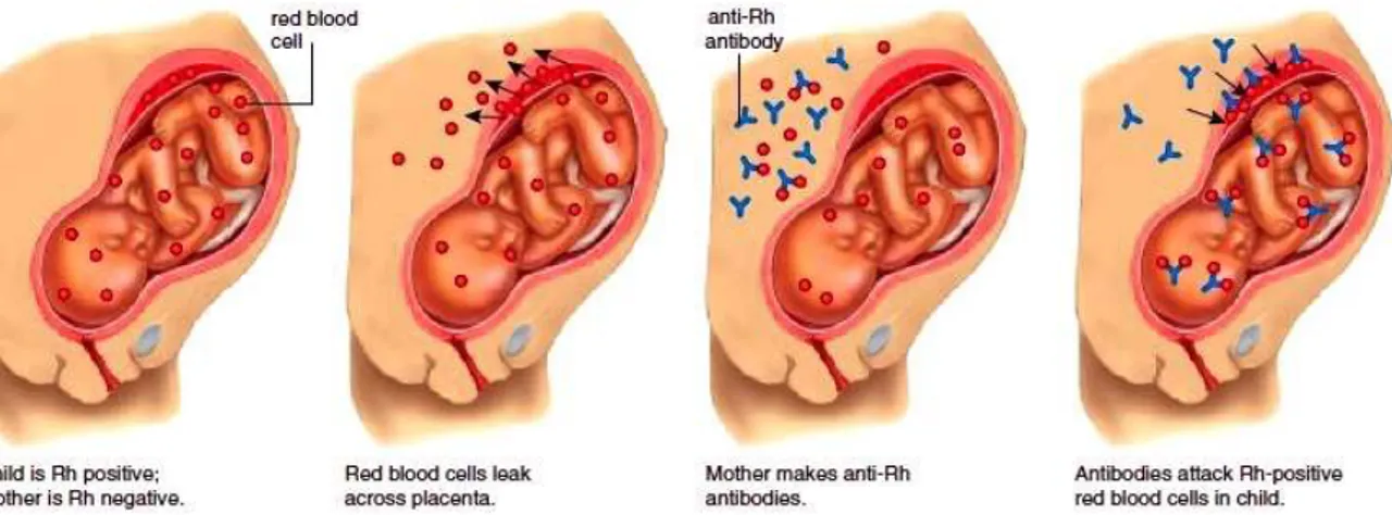 Figure 5 : Physiopathologie de la maladie hémolytique du fœtus et du nouveau-né 