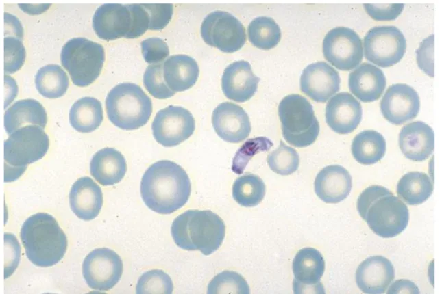 Figure 1. Frottis de sang : P. falciparum,  trophozoïtes, parasitémie à environ 12 % 