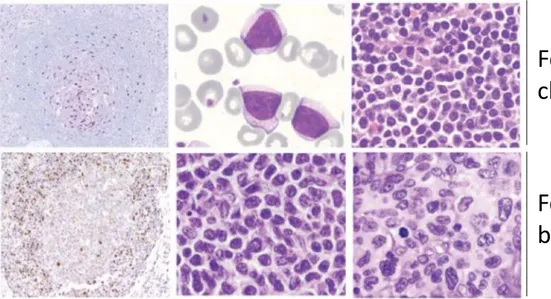 Figure  3 :  Hémogramme  issues  de  biopsies  ganglionnaires  mettant  en  évidence  les  lymphocytes  B  matures pathologiques dans le MCL