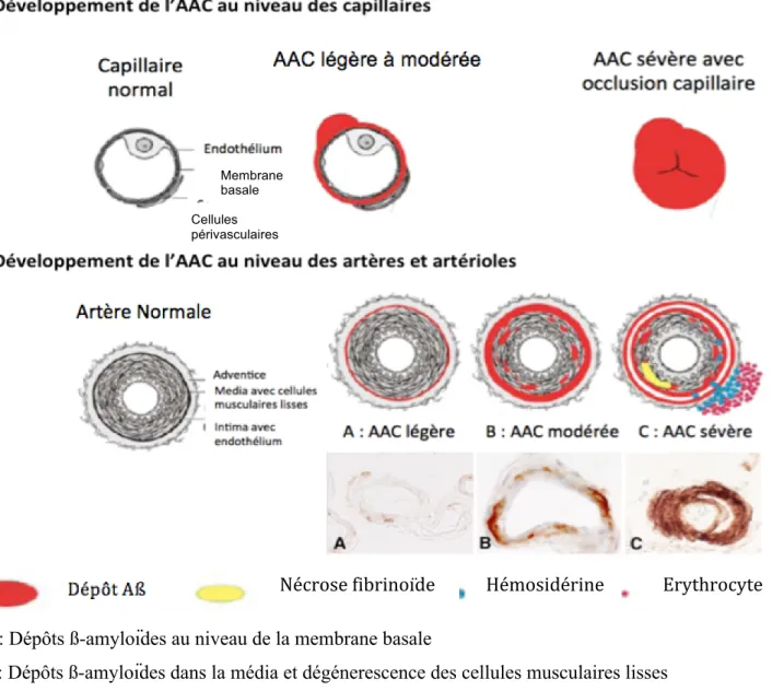 Figure 4 : Classement anatomopathologique en fonction du degré d’infiltration  amyloïde dans la paroi des vaisseaux (d'après Thal et al., 2008 et Kövari et al., 2013) 