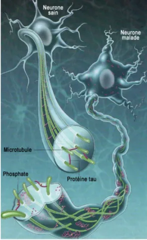 Figure  3 :  Schéma  de  la  protéine  tau  dans  un  neurone  sain  vs  un  neurone  malade (3) 