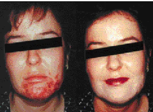 Figure n°5 : Effet de camouflage des lésions cutanées des patientes utilisant un maquillage correcteur 