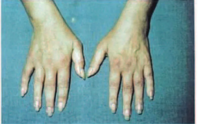 Figure 11 : Polyarthrite rhumatoïde débutante : doigts en fuseau [8] 