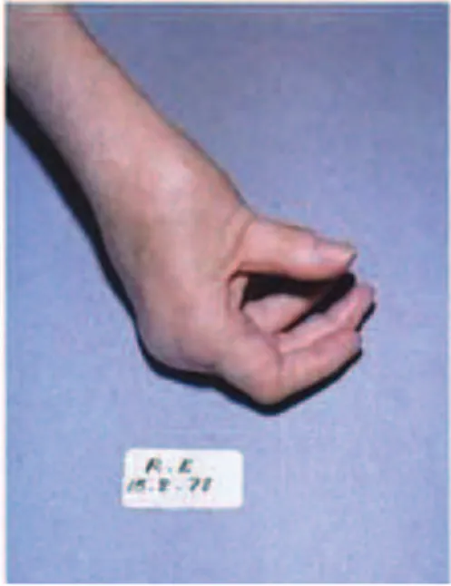Figure 15 : Avant-pieds plats triangulaires avec durillons dappui (A) ;   Griffe des orteils (B) [8] 