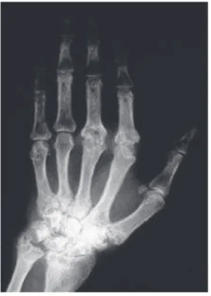 Figure 16 : Atteintes rhumatoïdes du carpe et des doigts [1] 