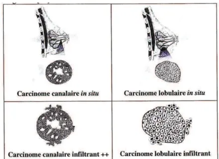 Figure 5 - Carcinomes mammaires in situ et infiltrants 