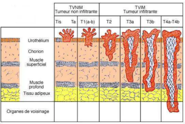 Figure 5 : Classification des tumeurs de la vessie (13) 