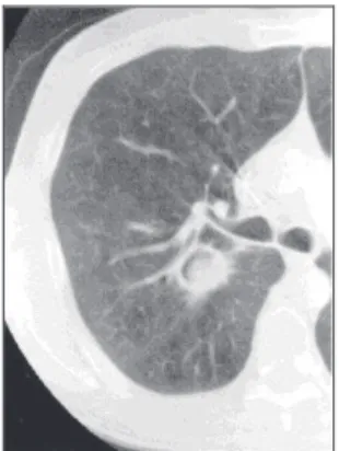 Figure 20 : Masse intracavitaire avec signe du croissant gazeux en tomodensitométrie  thoracique (20) 