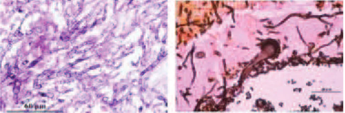 Figure 23 : mise en évidence d’éléments fongiques au niveau pulmonaire (mycélium septé et  tête conidienne) (D’après  http://frontal.univ-angers.fr) 