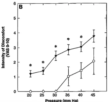 Figure 9 : Perception de la douleur viscérale mesurée par la méthode du barostat (ronds :  sujets témoins, triangles : patients avec SII) (17) 