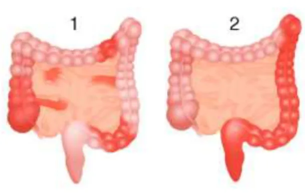 Figure 2 - Schéma illustrant la localisation d’une maladie de Crohn en 1, et celle d’une rectocolite hémorragique en 2 (5) 