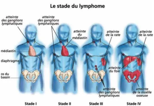 Figure 19 : illustration des différents stades de la classification d’Ann Arbor d’après  (63) 