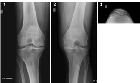 Figure 8. Radiographies d’un genou arthrosique (21) 