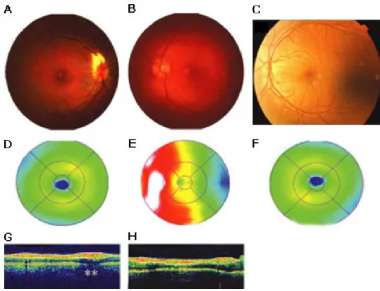 Figure 8 :  Comparaison  des  caractéristiques  oculaires  observées  sur  fond  d’œil  (A-C)  et  avec  l’OCT  (D-L)  chez des patients atteints de myélinisation persistante de la rétine et d’ARSACS et chez un patient sain
