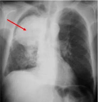 Figure 1 : cliché du thorax, présence d’une opacité sus-hilaire droite (flèche rouge)  (3)