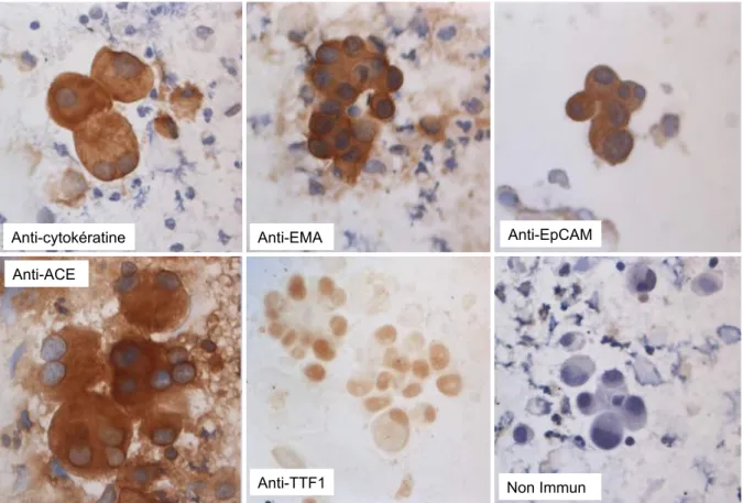 Figure 10 : Observation de résultats d’ICC (objx40) en fonction des anticorps utilisés (photographie provenant du service de  Biologie cellulaire du Pr.Roll à l’hôpital de la Timone)