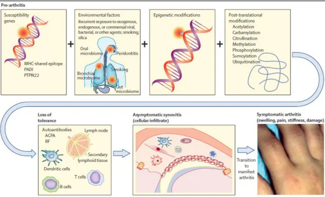 Figure 3 : La polyarthrite rhumatoïde, une pathologie d'origine multifactorielle où la combinaison de  facteurs génétiques, environnementaux, de modifications épigénétiques et post-translationnelles  amène à la perte de tolérance du système immunitaire et 