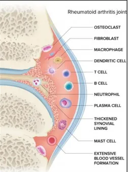 Figure 5 : Modification de la membrane synoviale et constitution de l'infiltrat cellulaire chez un  patient atteint de polyarthrite rhumatoïde (60) 