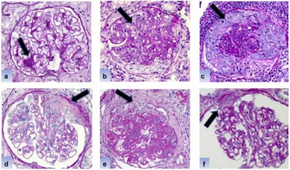 Figure 11 : Coupes histologiques montrant les principales lésions rencontrées au cours de la NL  Coloration PAS (Periodic Acid Schiff), les flèches noires montrent les lésions 