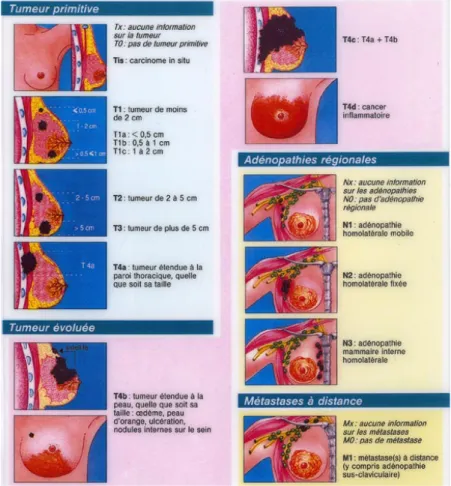 Figure 2 : Classification TNM illustrée des cancers du sein (16)