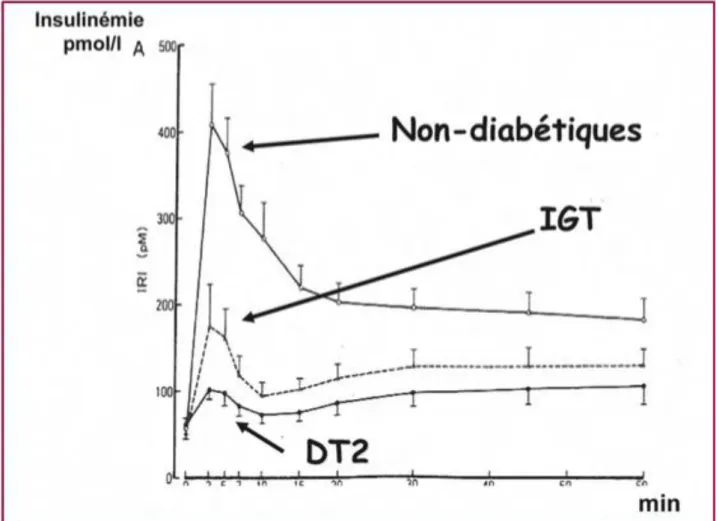 Figure 10: Anomalie de la phase précoce d'insulinosécrétion chez le patient diabétique type 2 [20] 