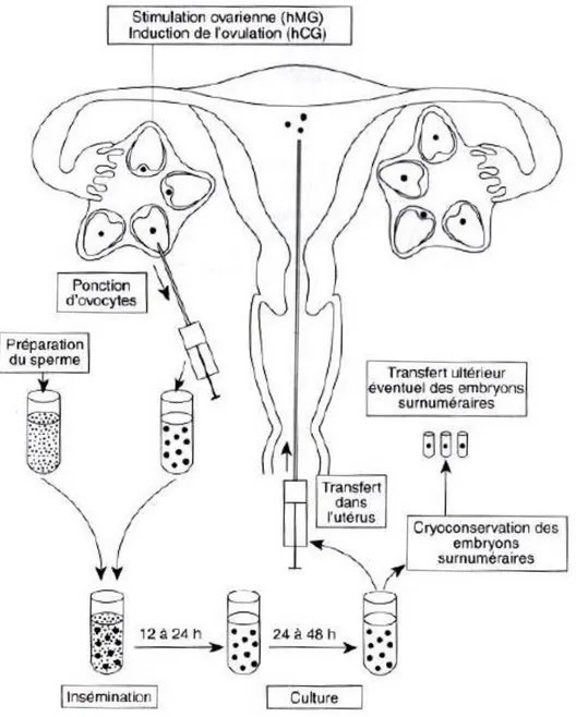 Figure 8 : Etapes de la fécondation in vitro (46) 
