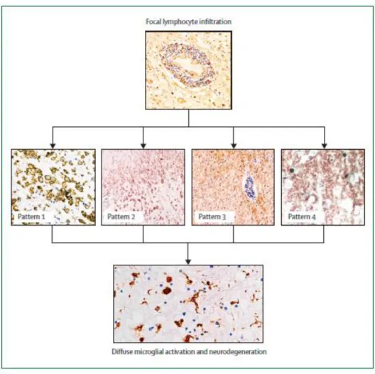 Figure 10 : Les 4 différents profils de plaques (16) 