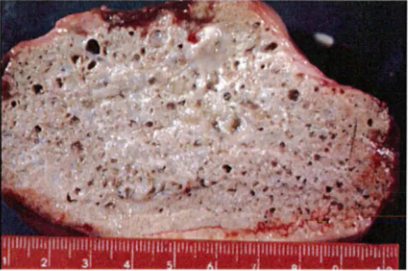 Figure  9 :  Aspect  macroscopique  de  l'échinococcose  alvéolaire  chez  l'homme :  section  de  foie  montrant  un  aspect  en  «  pain  bis  »  (laboratoire  de  Parasitologie, Strasbourg) 