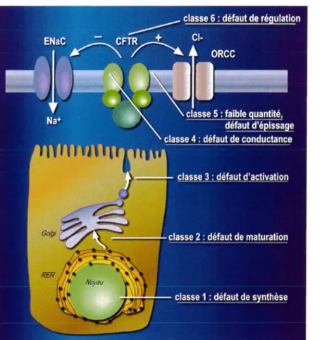 Figure 10  : Classification de la mucoviscidose en six classes 