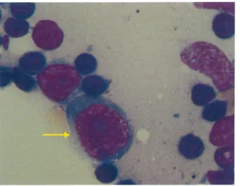 Figure 22  : Aspect cytologique d'un  immunoblaste 