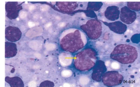 Figure 27  : Lymphocytes  à  noyau encoché ou irrégulier,  «  centrocyte-like » 