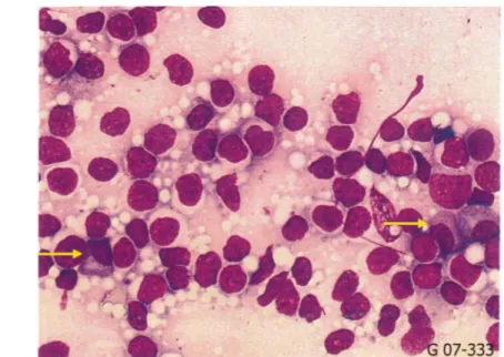 Figure 29 : Plasmocytes et lymphocytes  à des stades divers de différenciation plasmocytaire  Photo prise  à  partir d'une lame d'apposition ganglionnaire d'un  patient issu  de l'étude (objX50)  (Secteur cytologie, laboratoire d'hématologie cellulaire et 
