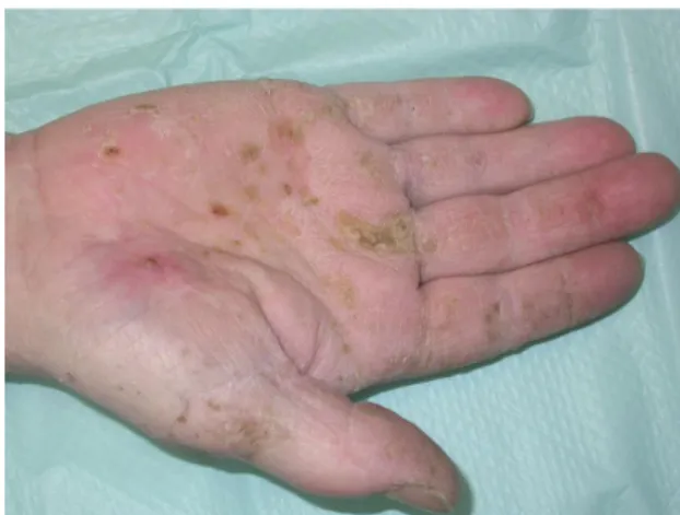 Figure 5 : Ongle avec des bandes de Mees