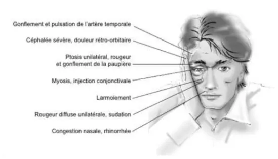 Figure 1 Symptomatologie de l'AVF 